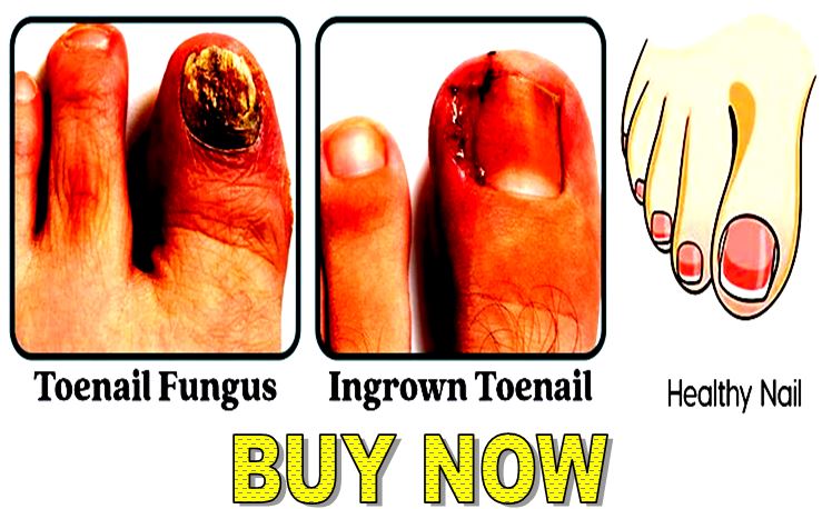 healthy vs infected toenail progression comparison